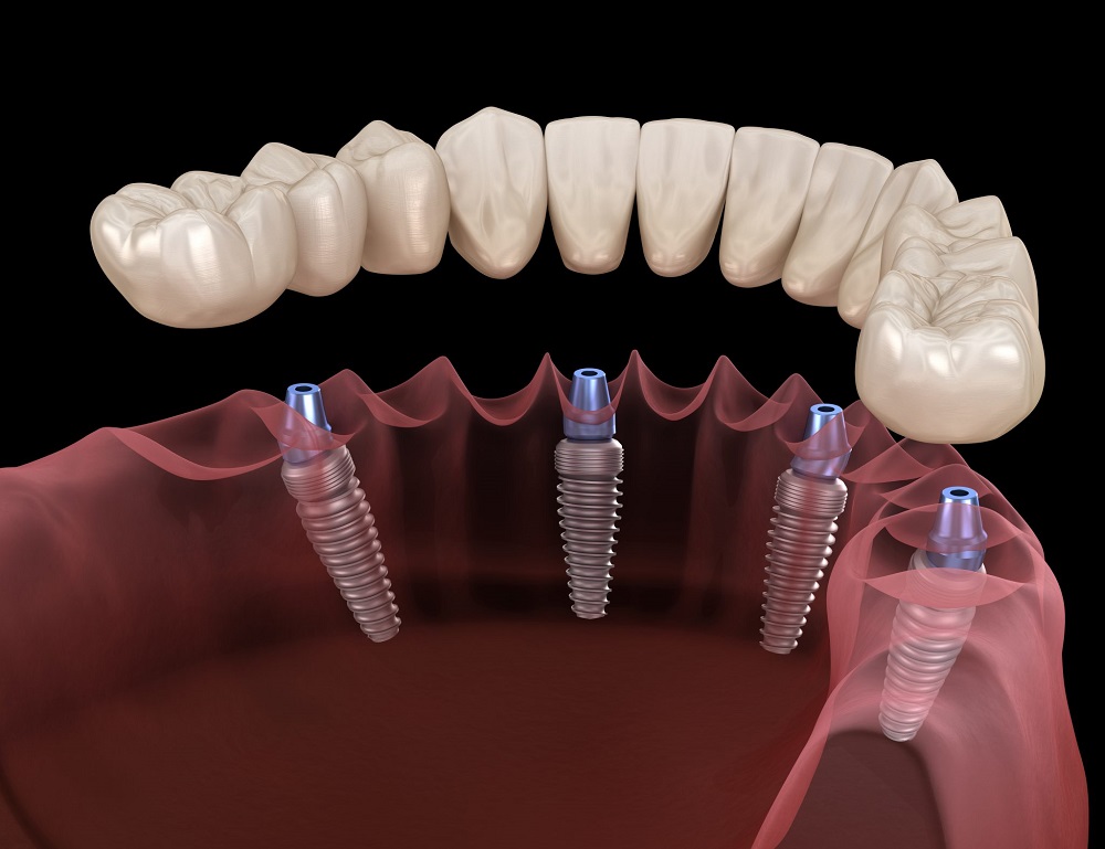 Установка имплантов при отсутствии всех зубов