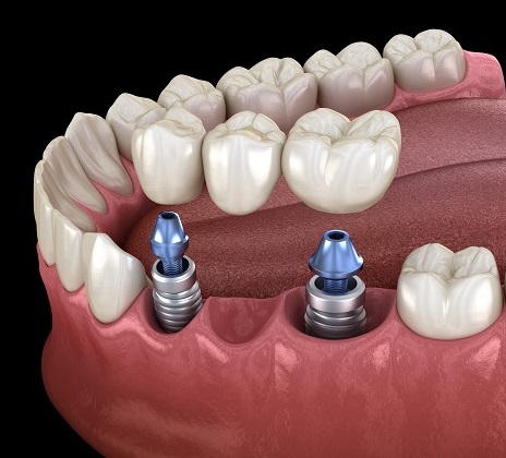 Установка имплантов при отсутствии 3 зубов