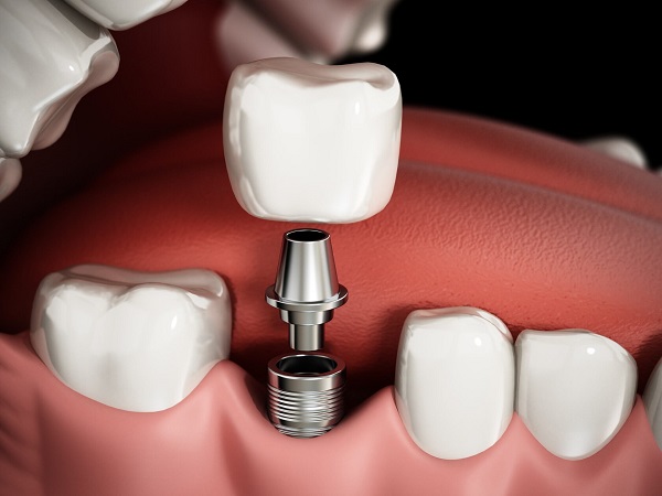 Установка импланта при отсутствии 1 зуба